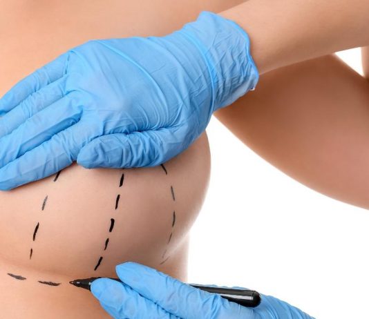 ניתוח הרמת חזה